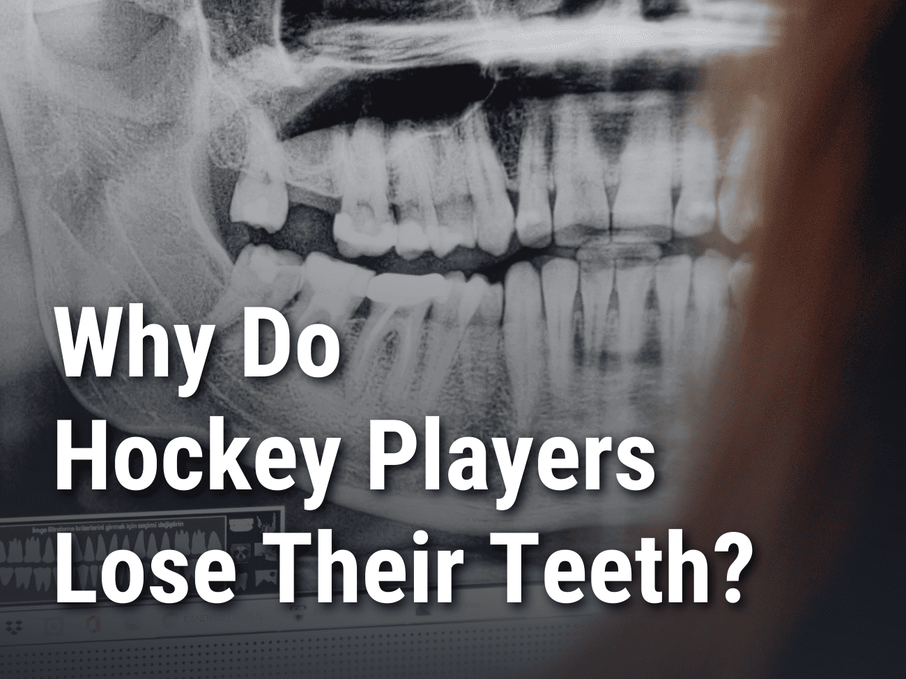 Why Do Hockey Players Lose Their Teeth? 4 Simple Reasons.